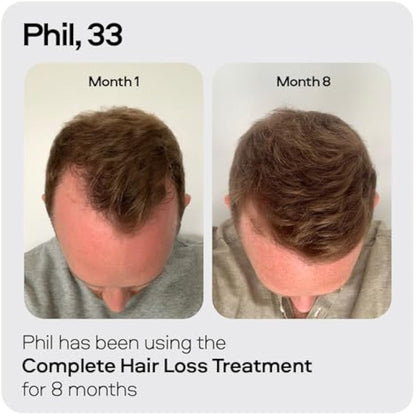 Sons Minoxidil 5% Cutaneous Solution for Men, Hair Regrowth & Thickener Formula, For Hair Loss & Thinning, Reactivates Shrunken Follicles, Precision Application System, 1 Month Supply Made in Europe