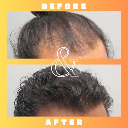 Mettle Mane - RU58841 5% Solution (50mg/ml) - DHT Blocker Hair Serum - 30ml Bottle