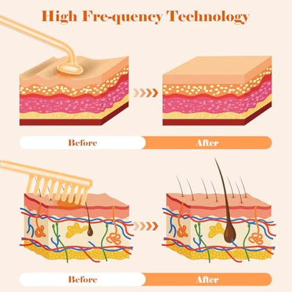 High F-requency Wand for Hair Growth, iklestar 6 PCS High F-requency Facial Machine Kit for Skin Care Home Salon Use