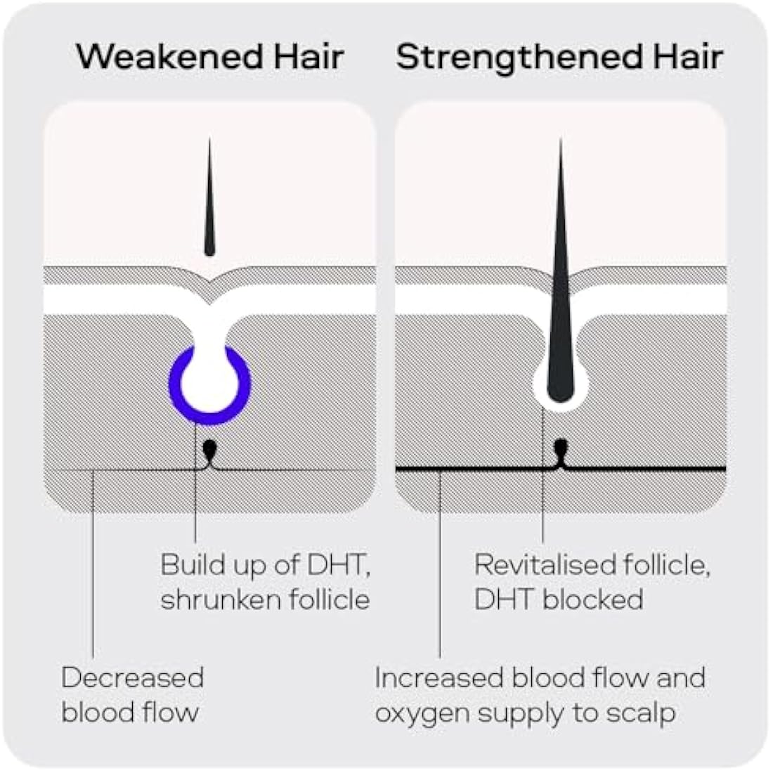 Sons Minoxidil 5% Cutaneous Solution for Men, Hair Regrowth & Thickener Formula, For Hair Loss & Thinning, Reactivates Shrunken Follicles, Precision Application System, 1 Month Supply Made in Europe