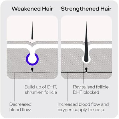 Sons Minoxidil 5% Cutaneous Solution for Men, Hair Regrowth & Thickener Formula, For Hair Loss & Thinning, Reactivates Shrunken Follicles, Precision Application System, 1 Month Supply Made in Europe