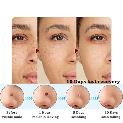 Skin Tag Remover Wart Eliminator Laser Plasma Pen Papillomas Electric Freckle Dark Spot Mole Removal Skin Tag Remover Pen